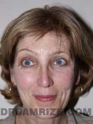 picture Female Postoperative Nose Surgery