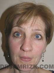 picture Female Preoperative Nose Surgery
