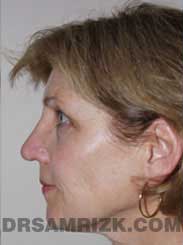 Female patient Post-Op rhinoplasty - side view