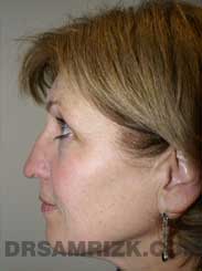 Female patient Pre-Op rhinoplasty - side view
