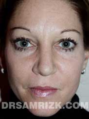 Female after rhinoplasty - photo