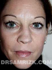 Female before Rhinoplasty