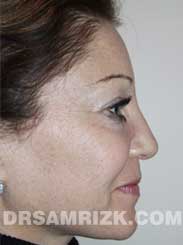 Female patient Postoperative rhinoplasty - side view