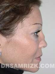Female patient Preoperative rhinoplasty - side view