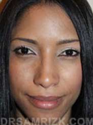 rhinoplasty after - image