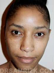 picture Hispanic/Dominican Female before Nose Job