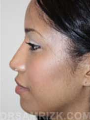 nose surgery after photo