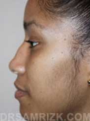 women rhinoplasty before - picture