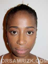 nose surgery patient after - picture