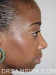 Female nose job after - side view