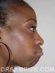 women rhinoplasty before - image