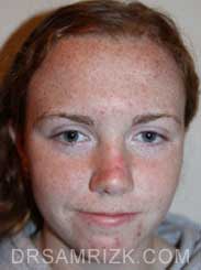 rhinoplasty before - front photo