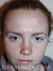 rhinoplasty after photo female patient