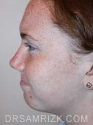 female after rhinoplasty - oblique view