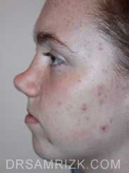 female nose job before oblique photo