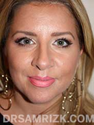 female nose job after - front view