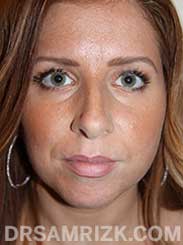 picture female before rhinoplasty