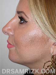 female patient before nose job - side view