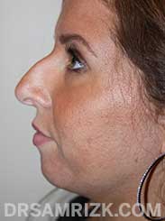 female patient after nose job - side view
