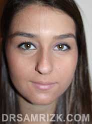 Female patient before Nose Surgery - image