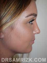 photo female after reconstructive rhinoplasty - side view