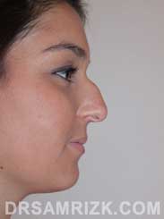 Female patient before Nose Job - pic