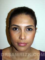 Female patient Post-Op rhinoplasty - photo