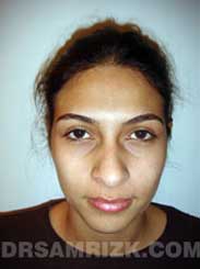 Female patient Pre-Op rhinoplasty - photo