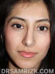 Female after Nose Surgery - picture