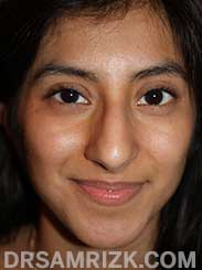 photo female before reconstructive rhinoplasty - front view