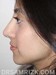 photo female after rhinoplasty - side view