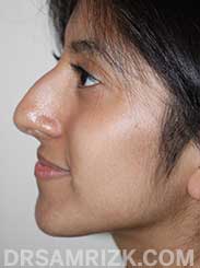 Female patient befor Nose Surgery - image