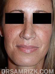 Female patient after Nose Surgery - pic