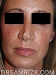 photo Female patient before Nose Surgery