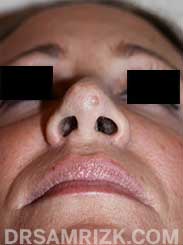 Female after Rhinoplasty - pic