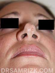 Female Pre-Op rhinoplasty - photo