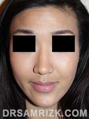 photo Asian Female patient after Rhinoplasty