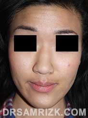 Female patient Nose Surgery - pic before