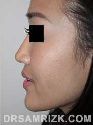 Asian Female after Rhinoplasty - pic