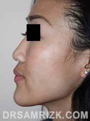 Female before reconstructive rhinoplasty - pic