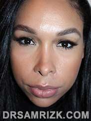 image female Post-Op Nose Surgery