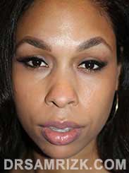 female patient Pre-Op rhinoplasty - pic