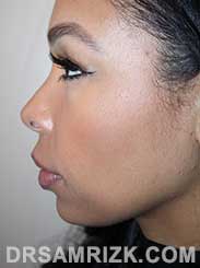 Female patient after Nose Surgery - photo