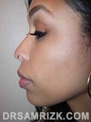 female patient before rhinoplasty - image