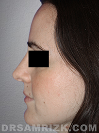 image female Post-Op Nose Surgery