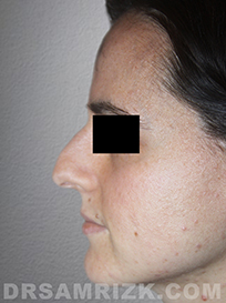 female patient Pre-Op rhinoplasty - pic