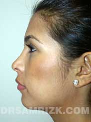 photo Latino female after rhinoplasty - front view