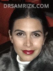 image Latino female after rhinoplasty - side view