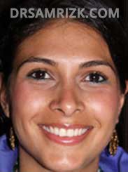 image Latino female after rhinoplasty - side view