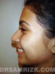 nose Latino surgery photography before